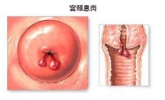 宫颈息肉手术治疗怎么样