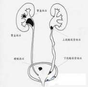 尿道结石疼痛怎么办