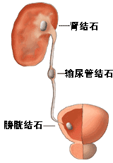 泌尿结石