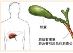 结石性胆囊炎是怎么回事?