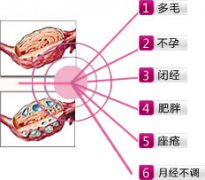 什么是多囊卵巢综合症？该如何治疗？